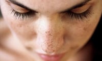 You can remove dark spots easily
